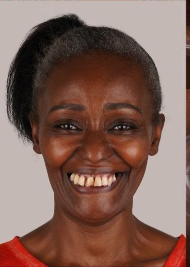 Mrs. Patricia Miller before All-on-4 treatment