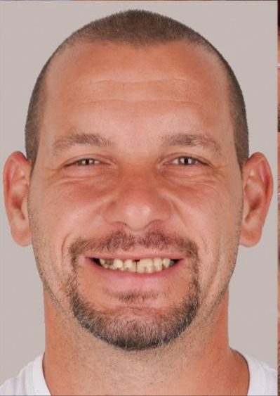 Mr. David Thompson before All-on-4 treatment