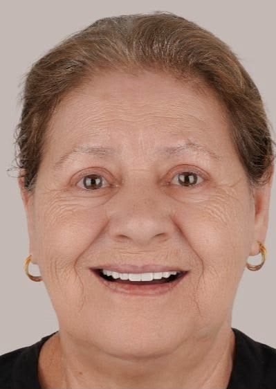 Mrs. Linda Williams after All-on-4 treatment