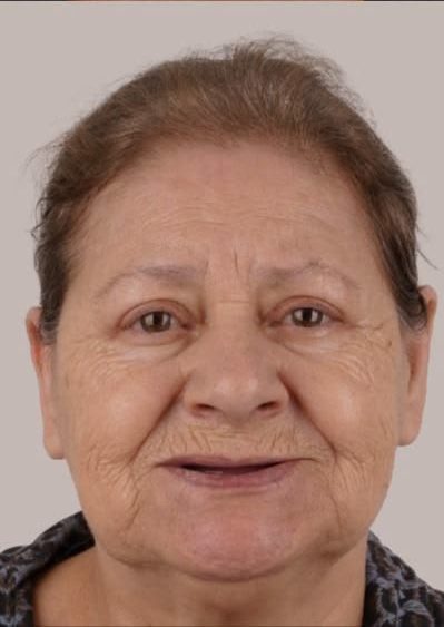 Mrs. Linda Williams before All-on-4 treatment
