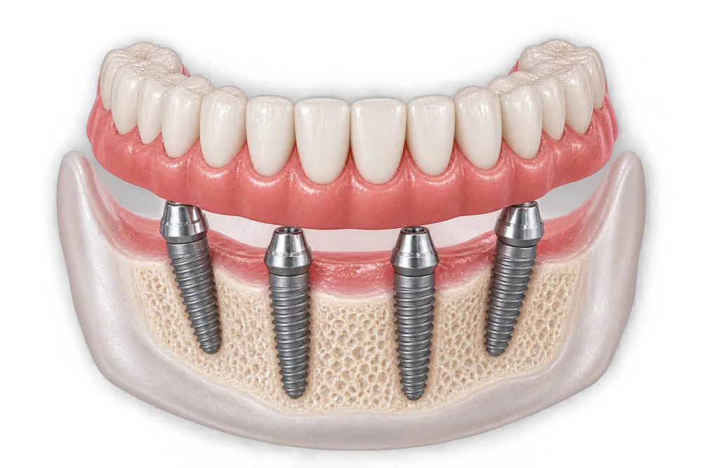 Illustration of a full-arch All-on-4® bridge on four titanium implants